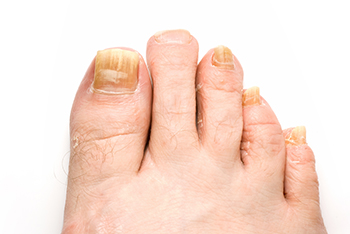 Toenail fungus treatment in the Canonsburg, PA 15317-1551 and McMurray, PA 15317 area